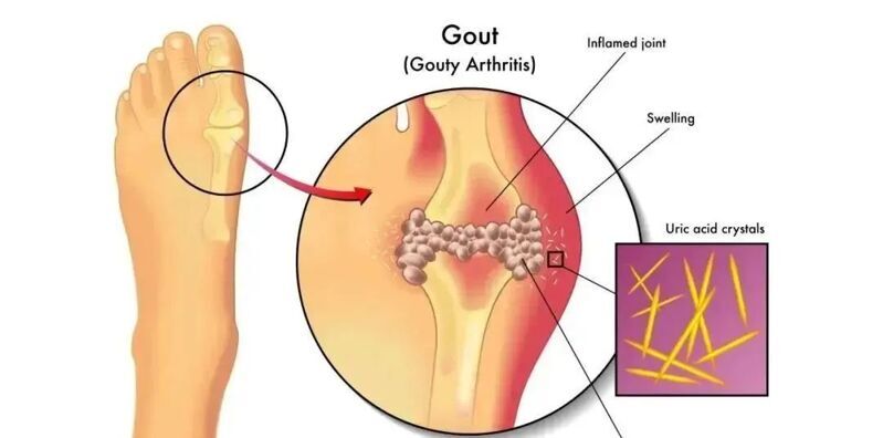 痛风“要命”？干细胞开辟新活路！终结剧痛不是梦~
